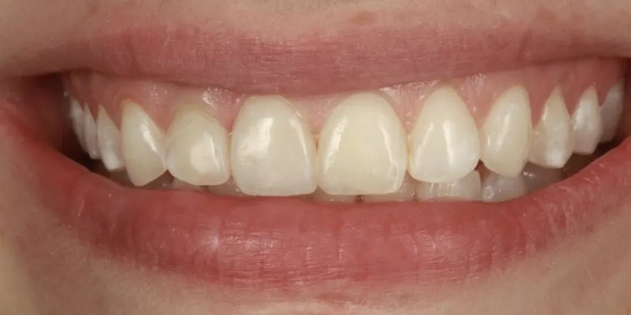 After: darker teeth disguised with composite