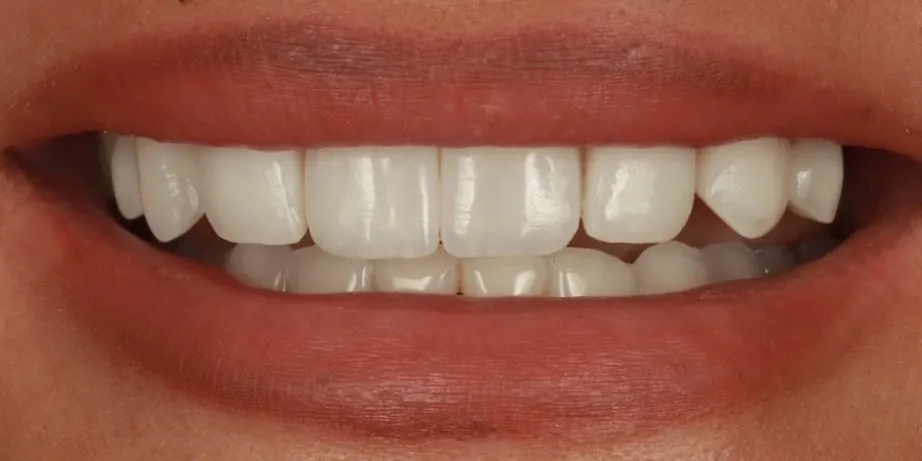 After: old, failing composite veneers removed and redone