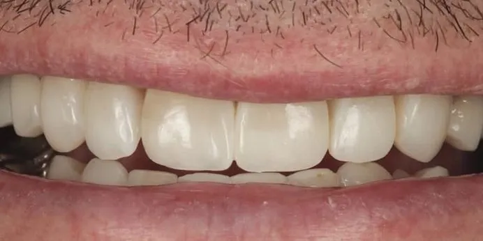 After: composite veneers in an age-appropriate shade as part of a wider rebuild